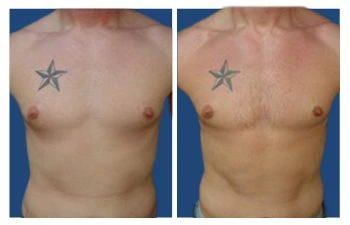 Gynecomastia Before & After Gallery: Patient 61