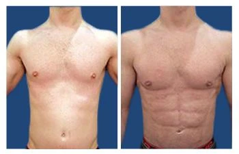 Men tummy tuck before and after - Gynecomastia Center of Los Angeles