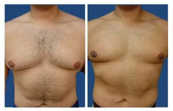 Gyno treatment results before and after - Gynecomastia Center of Los Angeles