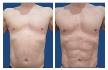 Tummy tuck before and after.