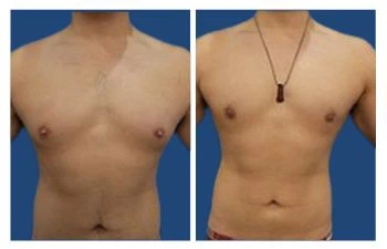 Gyno before and after.