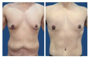 Gyno before and after.