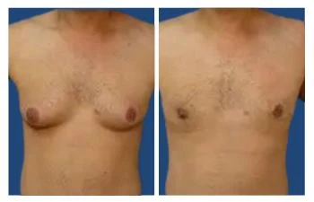 Grade 1 Gynecomastia Treatment - Gynecomastia LA