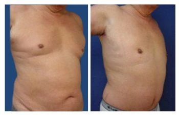 Gyno before and after results - Gynecomastia Center of Los Angeles