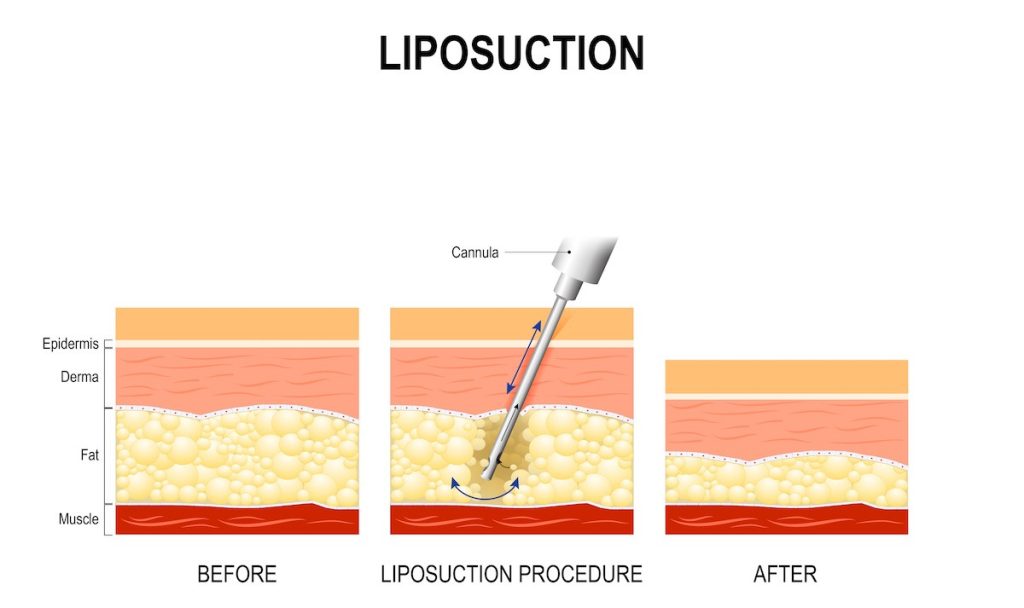 Liposuction for Male Nipple Surgery