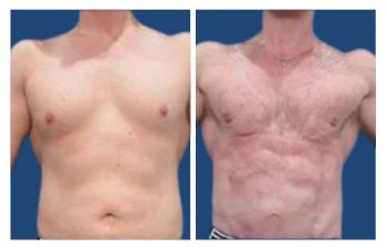 Gyno surger results - Gynecomastia Center of Los Angeles