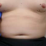 Male Nipple Surgery