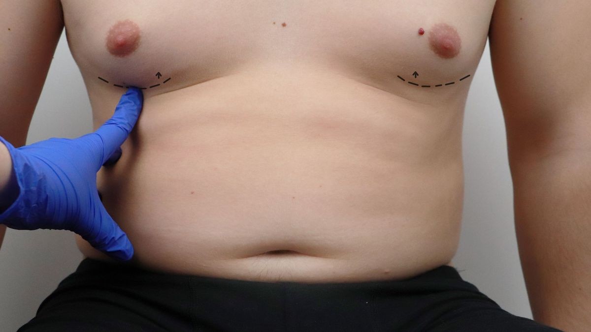 Male Puffy Nipple Surgery - Gynecomastia Center of Los Angeles