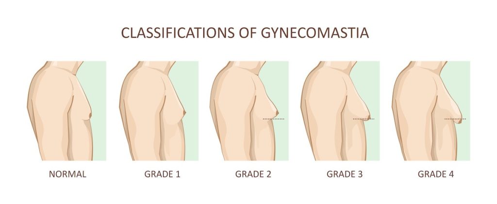 Gynecomastia grades 