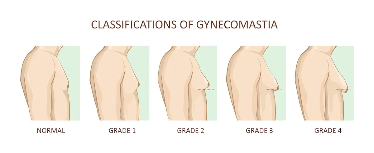 Classications of Gynecomastia