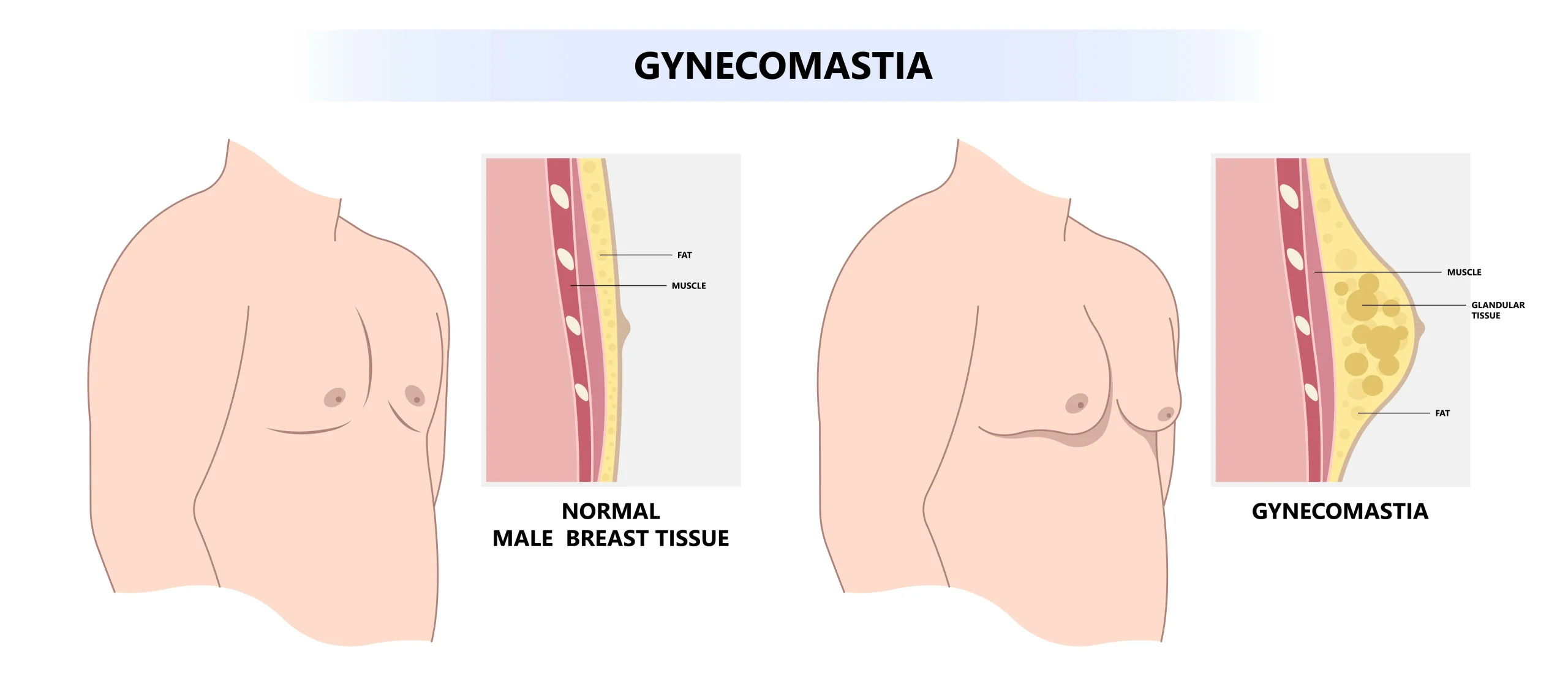 Nomal vs gynecomastia