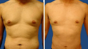 Before and after comparison of a male torso following Grade 1 Gynecomastia Treatment.