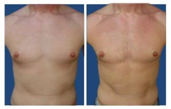 Before and After photos depicting gynecomastia treatment results.