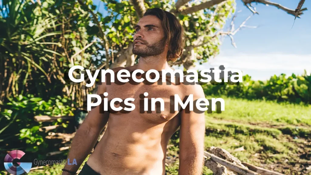 Gynecomastia Pics in Men LA, CA
