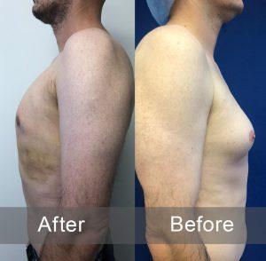 Before and After Gynecomastia Gallery in LA, CA