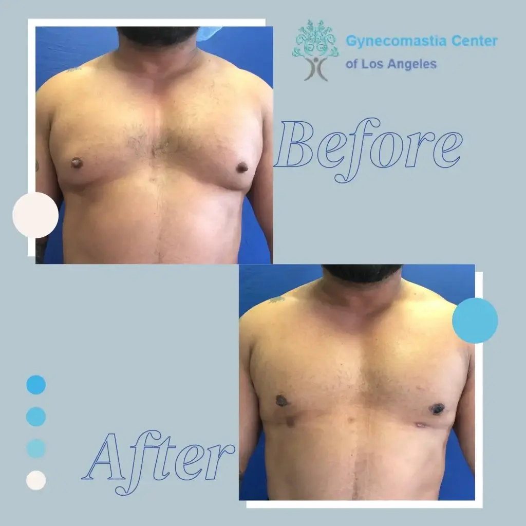 Gynecomastia in Overweight Men In & Near Los Angeles