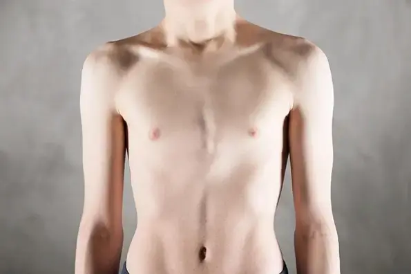 Gynecomastia in Teens