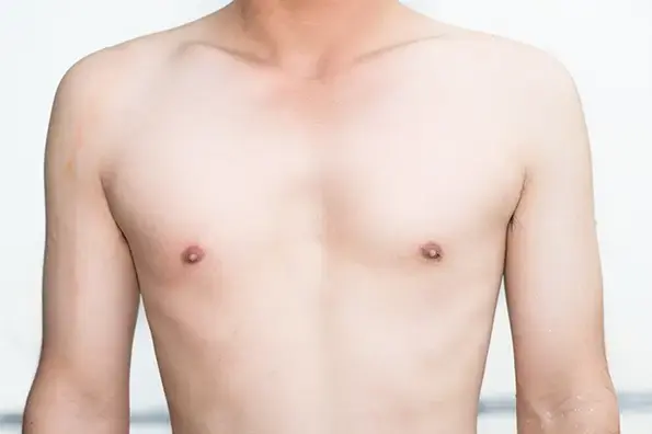 Normal Gynecomastia