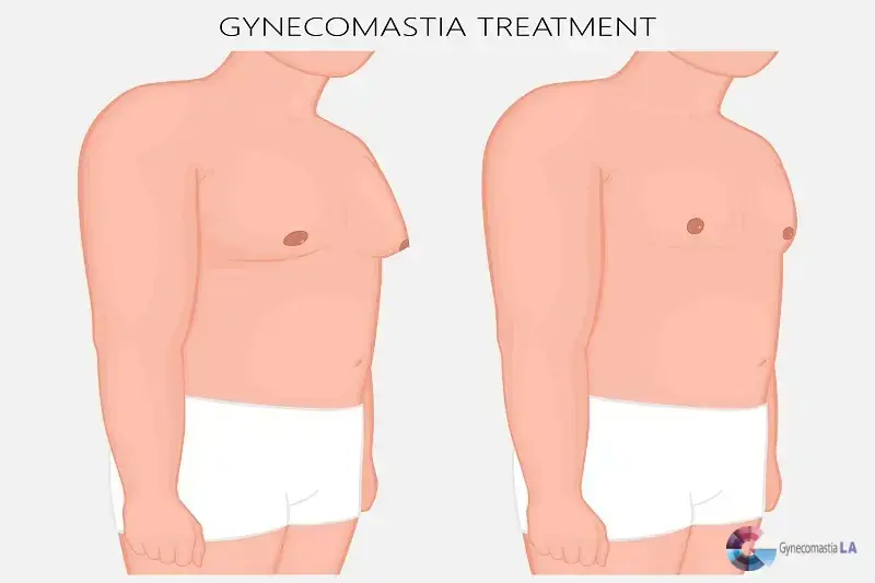 Causes of Gynecomastia- Expert insight from Gynecomastia La center