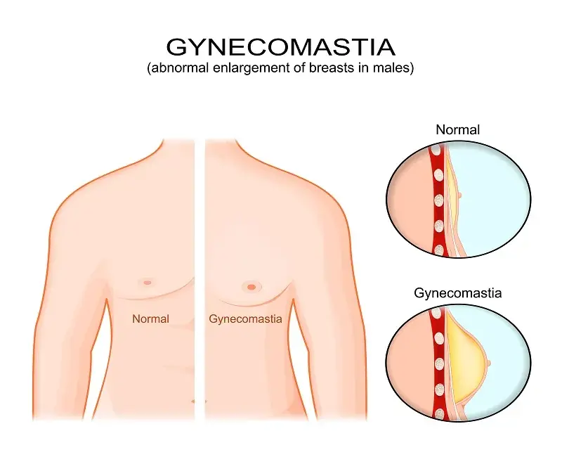 Symptoms of Grade 3 GYNECOMASTIA in Los Angeles, CA