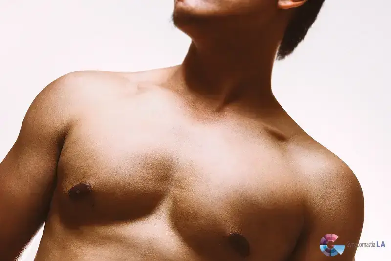 When Gynecomastia will go away? Dr. Moein help you in Los Angeles, CA