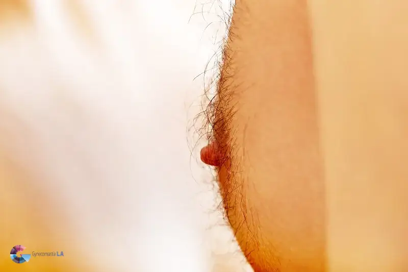 Do Insurance Coverage Puffy Nipple Surgery?