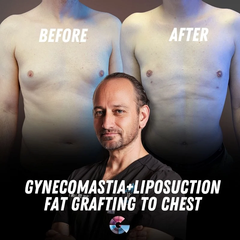 Gynecomastia Surgeon LA Dr. Moein