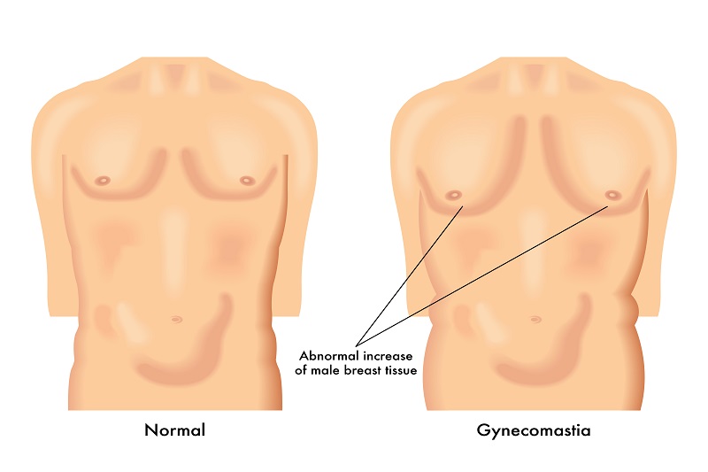 Gynecomastia and Hormones