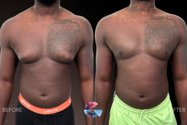 Gynecomastia Surgery Before and After in Los Angeles CA