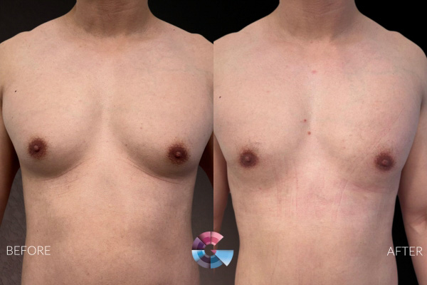 Gynecomastia Surgery Before and After in Los Angeles, CA