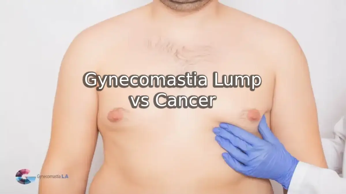 Gynecomastia Lump vs Cancer: Key Insights for Men