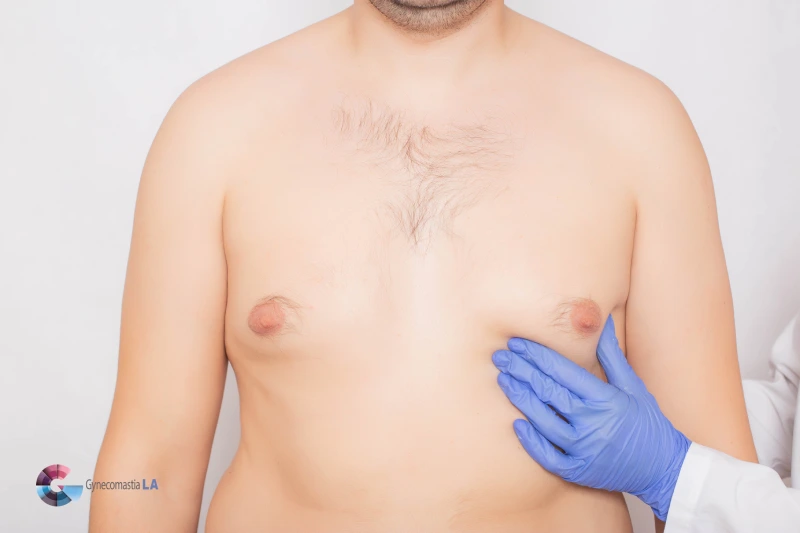 Severe Gynecomastia Cases in Los Angeles, CA