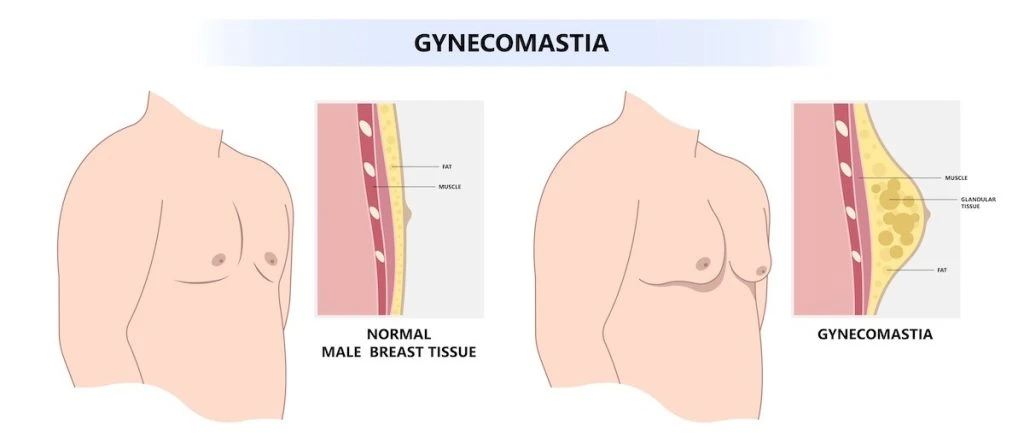 Gynecomastia Puffy Nipples Los Angeles CA Gynecomastia Puffy Nipples Los Angeles CA