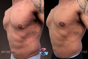 Gynecomastia Surgery Before And After in Los Angeles Gynecomastia Surgery Before And After in Los Angeles