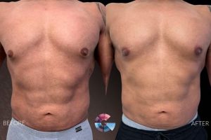 Gynecomastia Surgery Before And After in Los Angeles Gynecomastia Surgery Before And After in Los Angeles