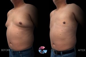 Gynecomastia Surgery Before And After in LA Gynecomastia Surgery Before And After in LA