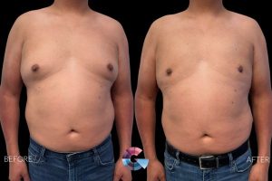 Gynecomastia Surgery Before and After in Los Angeles CA Gynecomastia Surgery Before and After in Los Angeles CA