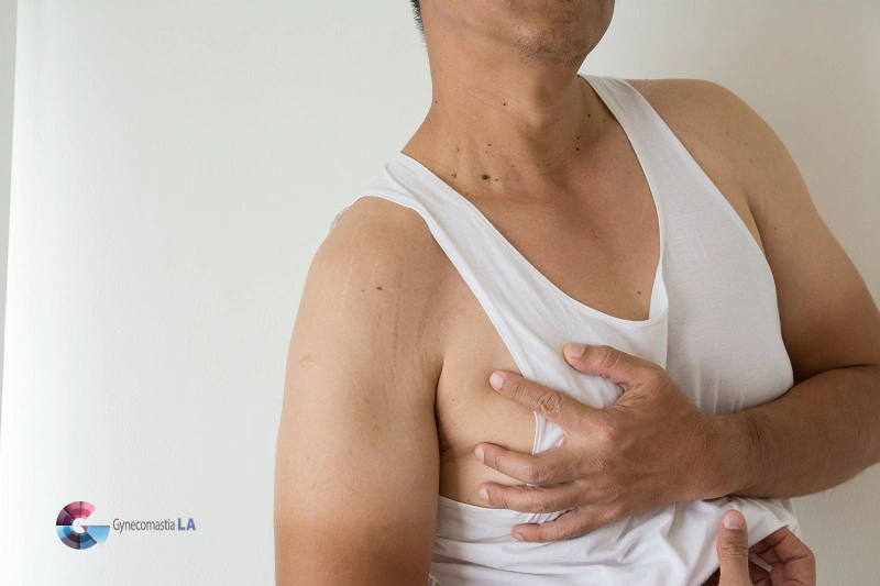 Evaluation Of Nipple Pain At GynecomastiaLA