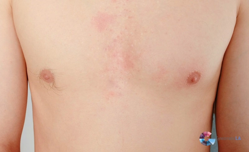 Nipple Dermatitis in Men