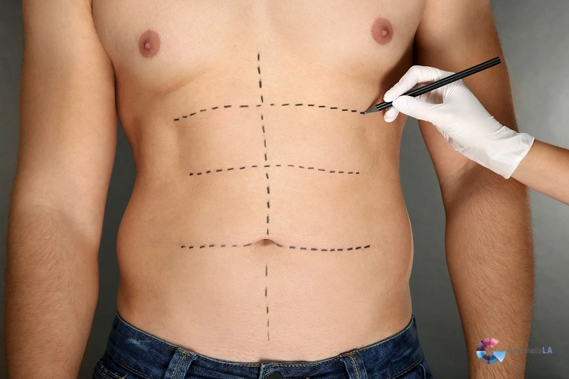 Waistline Narrowing in Men Waistline Narrowing in Men-Tips from Dr. Moein in LA