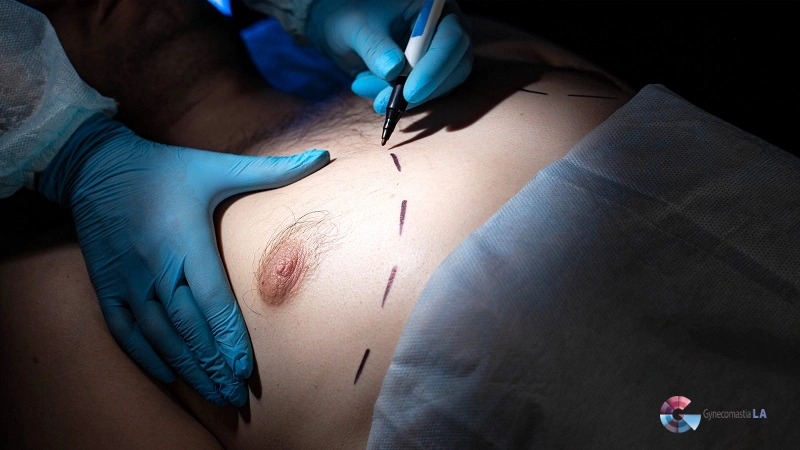 Can Gynecomastia Return After Surgery