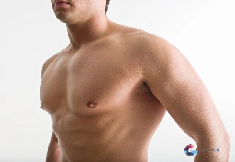 Bodybuilders with Gynecomastia
