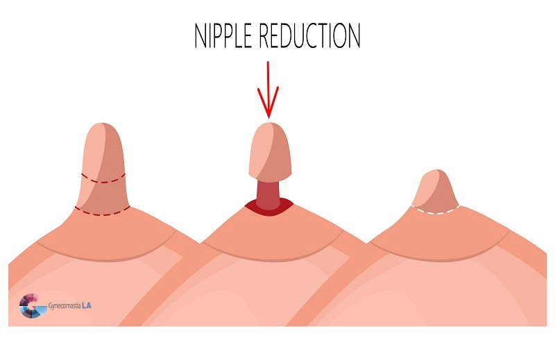Male Nipple Reduction Procedure Explained