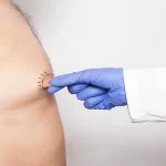 Male Nipple Reduction in Los Angeles
