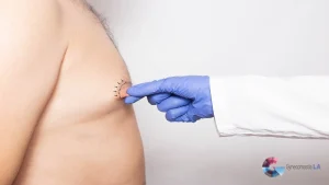 Male Nipple Reduction in Los Angeles