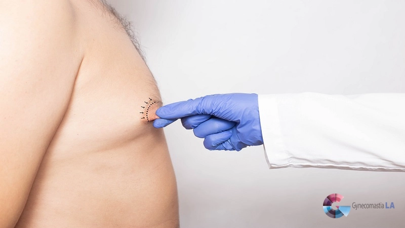 Male Nipple Reduction in Los Angeles