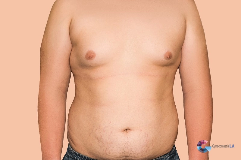 Puffy Nipples (Grade I) | Tips from Dr. Moein in LA