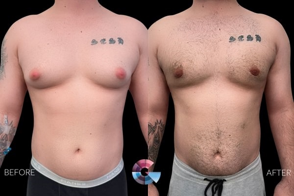 gynecomastia surgery cost in Los Angeles - before and after results by Dr. Moein