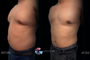 Grade 3 gynecomastia before and after in LA Grade 3 gynecomastia before and after in LA