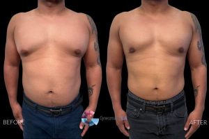 Grade 3 Gynecomastia Before and After in Los Angeles Grade 3 Gynecomastia Before and After in Los Angeles